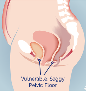 poate pierderea în greutate cauza prolaps uterin